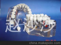 供應(yīng)樹(shù)脂牙齒二倍全透明成人病理種植模型